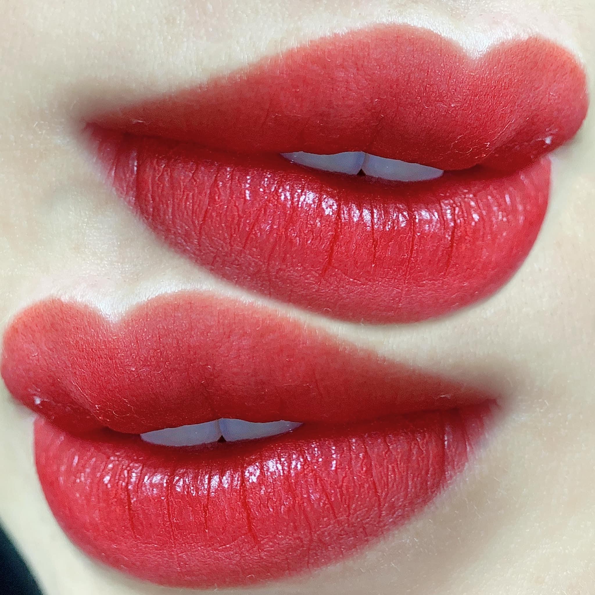 Gói trị mụn