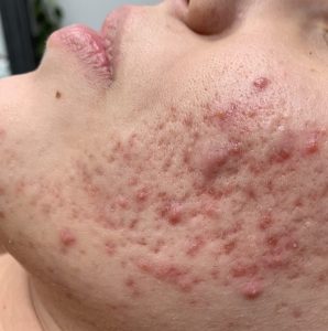 Chăm sóc da mụn, rỗ